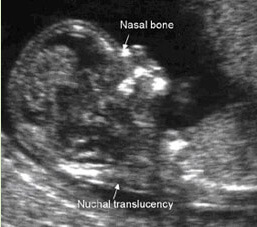 First Trimester Screening (FTS)