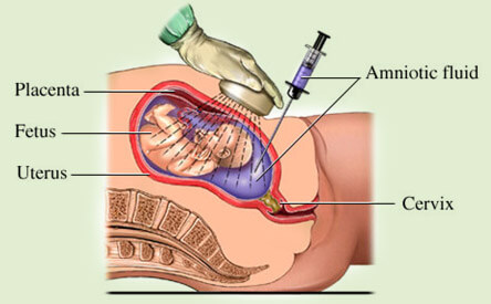 Amniocentesis