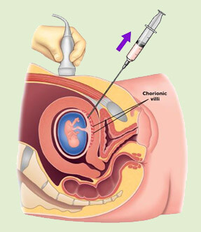 Chorionic Villus Sampling (CVS)