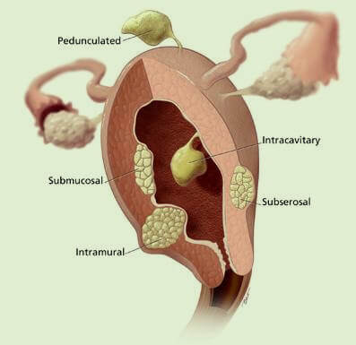 Uterine Fibroids