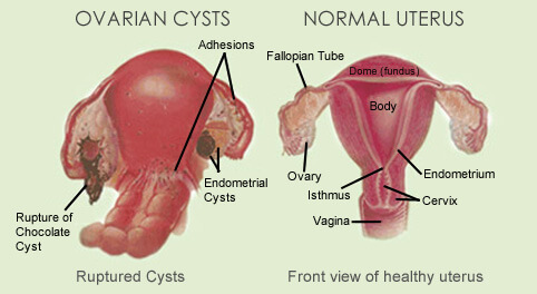 Endometriosis