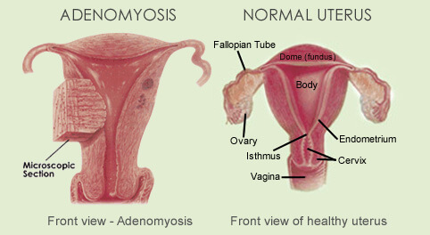 Endometriosis