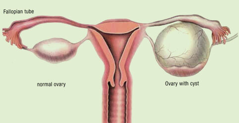 Ovarian Cysts