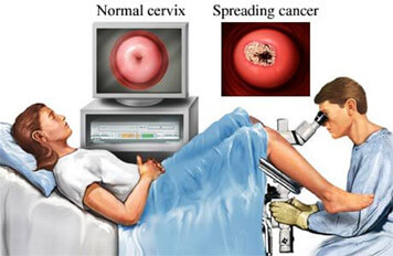 Colposcopy