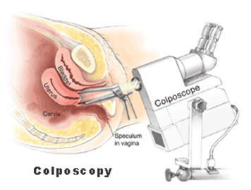 Colposcopy