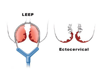 LEEP (Loop Electrosurgical Excision Procedure) and Cone Biopsy