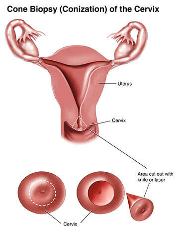 LEEP (Loop Electrosurgical Excision Procedure) and Cone Biopsy