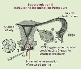 Super-Ovulation and Intra-Uterine Insemination (SO-IUI)