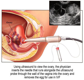 In-Vitro Fertilization (IVF) and Intra-Cytoplasmic Sperm Injection (ICSI)