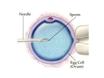 In-Vitro Fertilization (IVF) and Intra-Cytoplasmic Sperm Injection (ICSI)