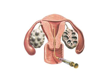 In-Vitro Fertilization (IVF) and Intra-Cytoplasmic Sperm Injection (ICSI)