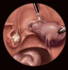 Laparoscopy removal of the womb