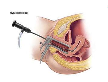 Hysteroscopic Procedures