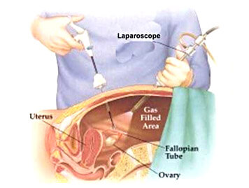 Laparoscopic Surgery