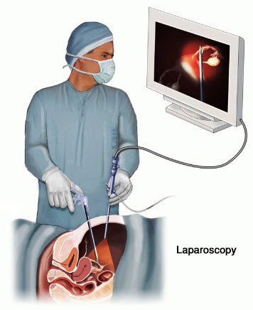 Laparoscopic Surgery