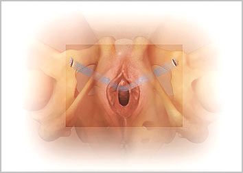 Uterine prolapse